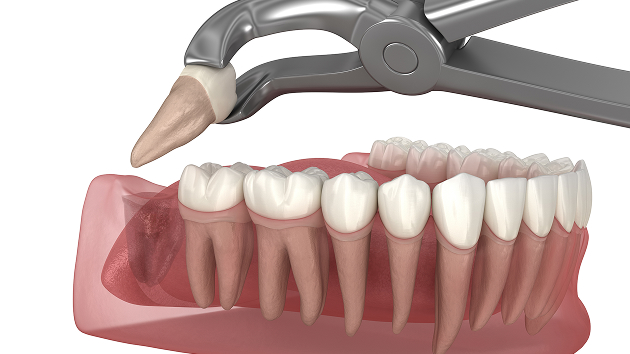 Dental Implants
