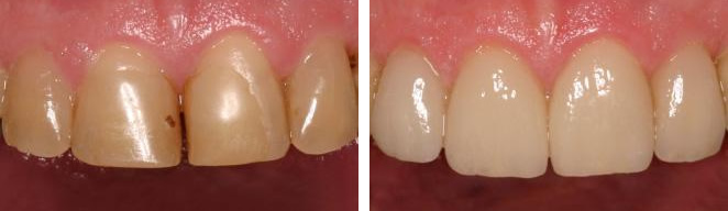 CEREC Restoration Before and After – Case 1