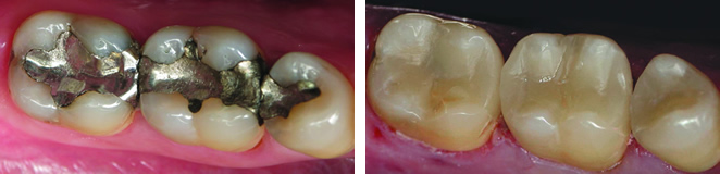 CEREC Restoration Before and After – Case 2