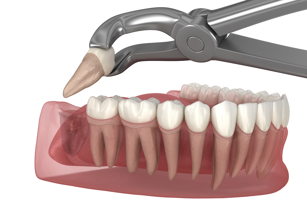 Gentle tooth extraction care